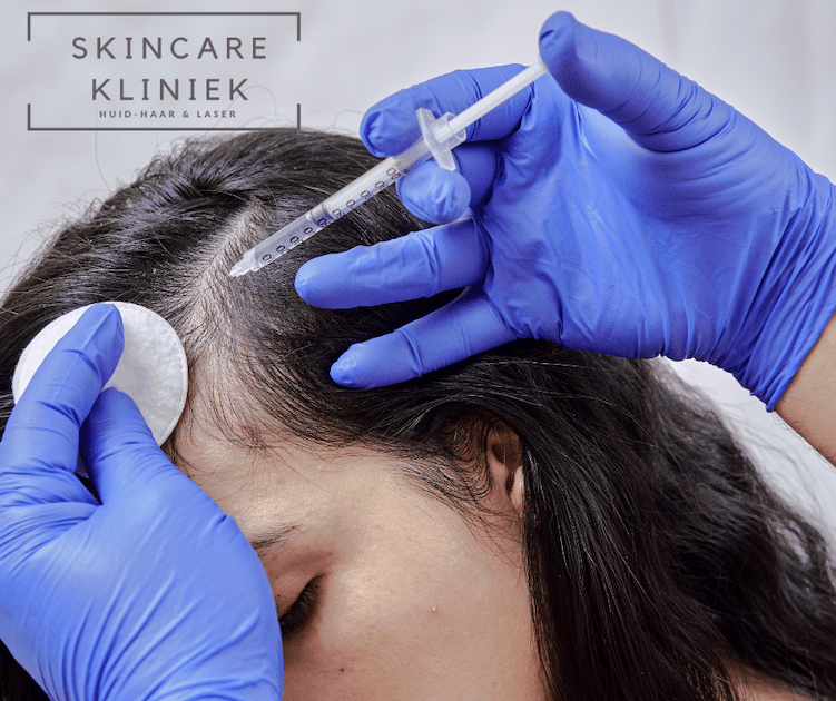 Mesotherapie bij haaruitval Skincare Kliniek