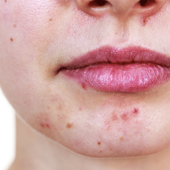 Acne behandeling Den Haag en omgeving Delft en Rijswijk