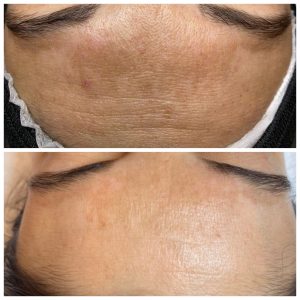 Melasma op voorhoofd