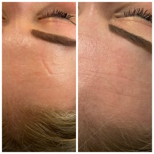 Co2 fractional laser littekens behandelen