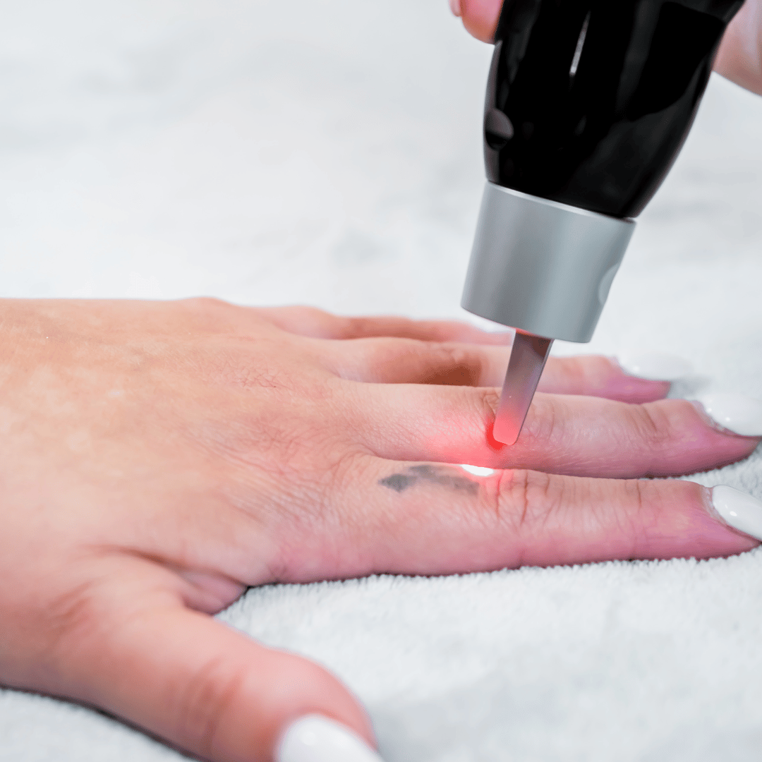 Tattoo en PMU verwijderen met laser