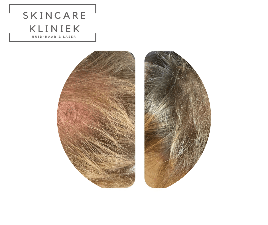 Voor en na resultaat mesotherapie haar