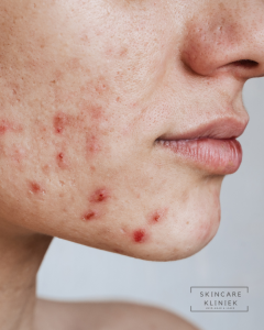 Acne peeling gezicht Rijswijk
