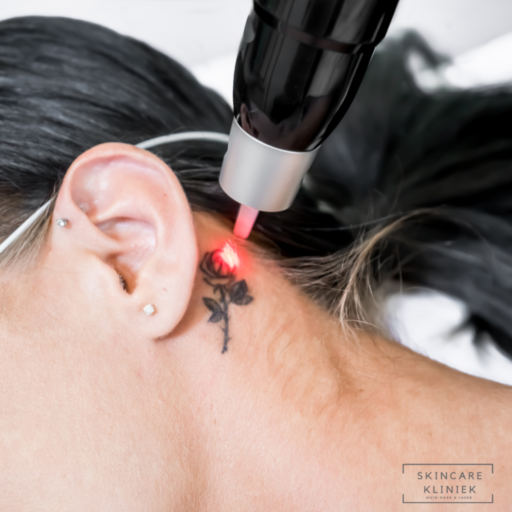Tattoo laser Den Haag, Rijswijk, Delft, Nootdorp, Pijnacker