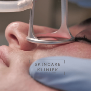 Co2 fractional laser Rijswijk, Den Haag voor rimpels
