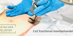 Co2-fractional-laserbehandeling-e1692728422895