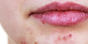 Acne behandeling Den Haag en omgeving Delft en Rijswijk