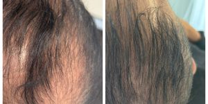 Resultaat na mesotherapie