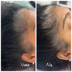 Resultaat mesotherapie haaruitval