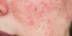Rosacea behandeling huidkliniek Den Haag