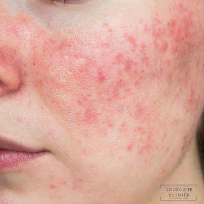 Rosacea behandeling huidkliniek Den Haag