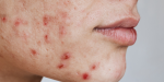 Acne behandeling Rijswijk, Delft