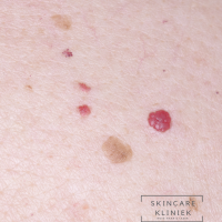 Cherry angioma, bloedblaar verwijderen