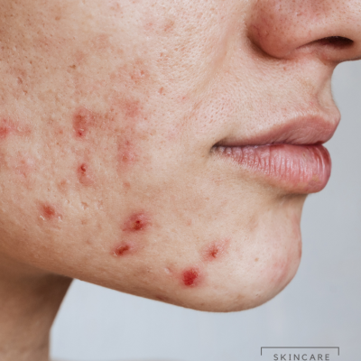 Acne peeling gezicht Rijswijk