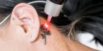 Tattoo laser Den Haag, Rijswijk, Delft, Nootdorp, Pijnacker