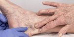 vaatlaser behandeling gezicht laser voor rode vaatjes neus couperose laser Rijswijk rode vaatjes verwijderen gezicht gesprongen haarvaatjes laser vaatlaser benen kleine vaatjes blauwe beenvaatjes behandelen laser paars vaatje laser behandeling huidtherapeut vaatlaser Rijswijk voor en na vaatlaser resultaat laser tegen roodheid huid couperose wangen laserbehandeling vaatlaser kliniek Rijswijk Den Haag Delft