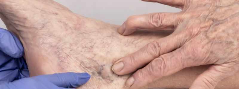 vaatlaser behandeling gezicht laser voor rode vaatjes neus couperose laser Rijswijk rode vaatjes verwijderen gezicht gesprongen haarvaatjes laser vaatlaser benen kleine vaatjes blauwe beenvaatjes behandelen laser paars vaatje laser behandeling huidtherapeut vaatlaser Rijswijk voor en na vaatlaser resultaat laser tegen roodheid huid couperose wangen laserbehandeling vaatlaser kliniek Rijswijk Den Haag Delft