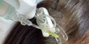 Mesotherapie haar Rijswijk/ Delft en Den Haag