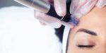 Dermapen behandeling Rijswijk, Delft en Den Haag