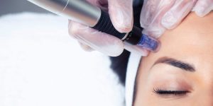 Dermapen behandeling Rijswijk, Delft en Den Haag