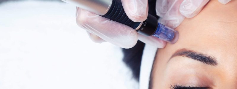 Dermapen behandeling Rijswijk, Delft en Den Haag