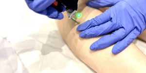 Vaatjes verwijderen met laser in Rijswijk, Delft of Den Haag