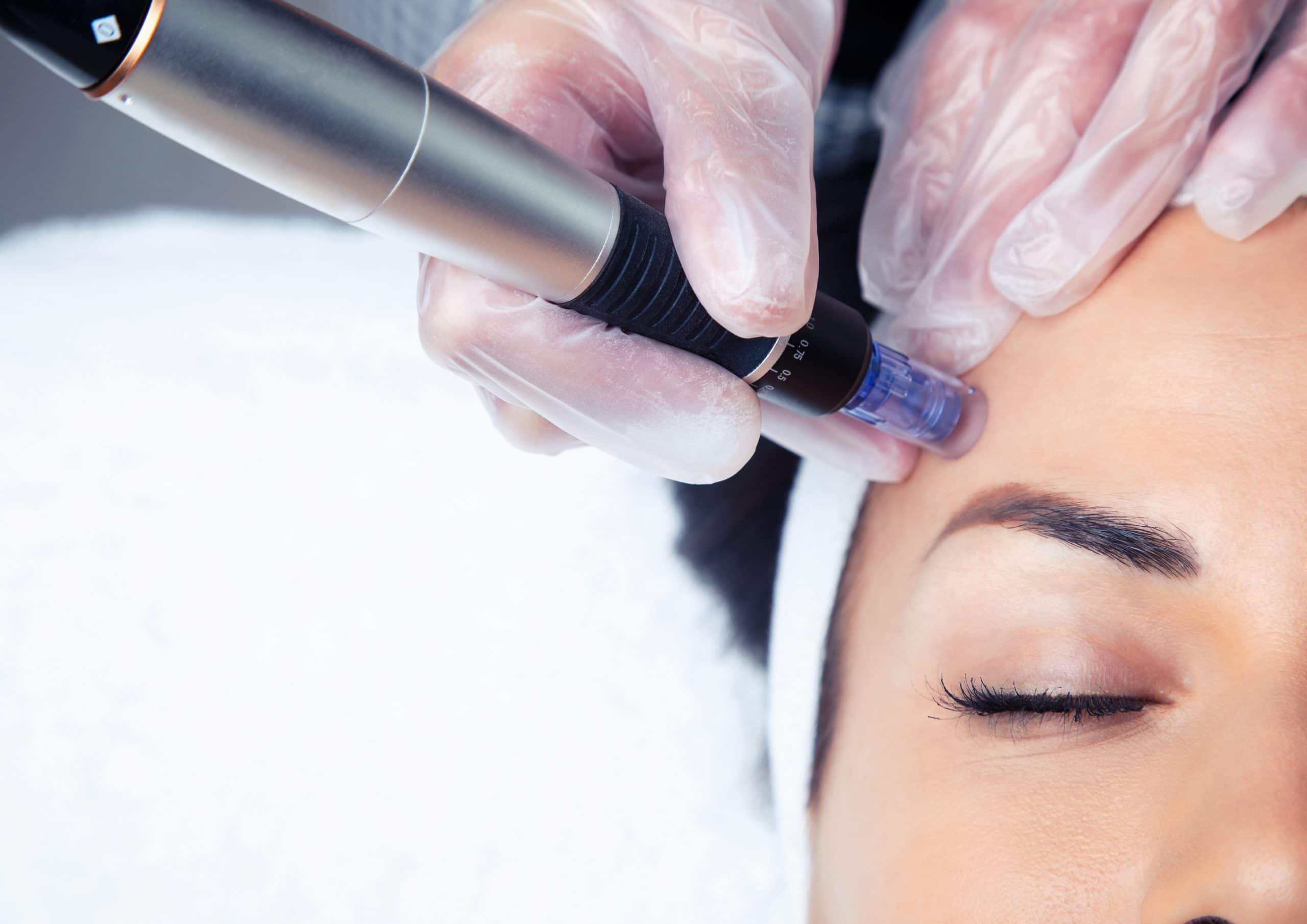 Microneedling behandeling Skincare Kliniek Rijswijk