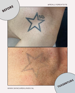 Voor en na resultaat picolaser Tattoo verwijderen Den Haag